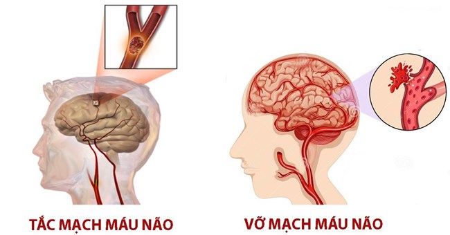 Phòng ngừa, điều trị bệnh đột quỵ ngày càng trẻ hóa (27/7/2024)